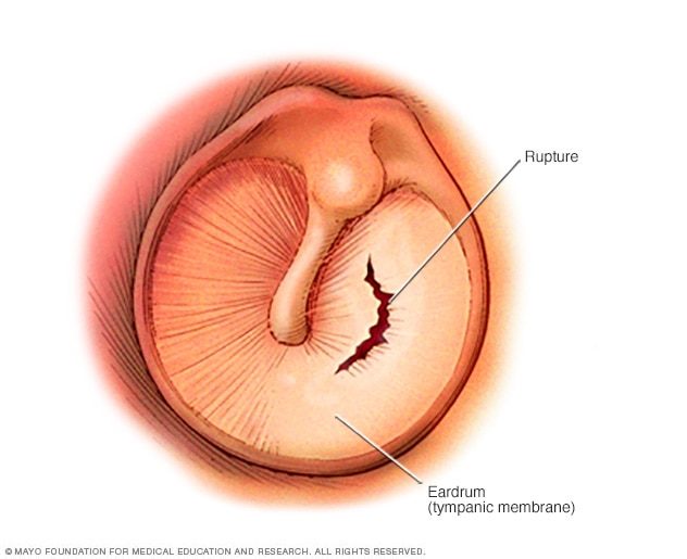 In some cases, it may bruise the eardrum or rupture the oval window and lead to a temporary hearing loss